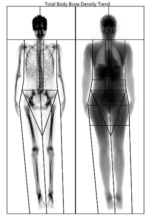 X-ray of skeletal bone density from DEXA scan