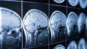 Brain scans up on a backlight, a procedure that can be costly, where neurocognitive testing is affordable and as effective