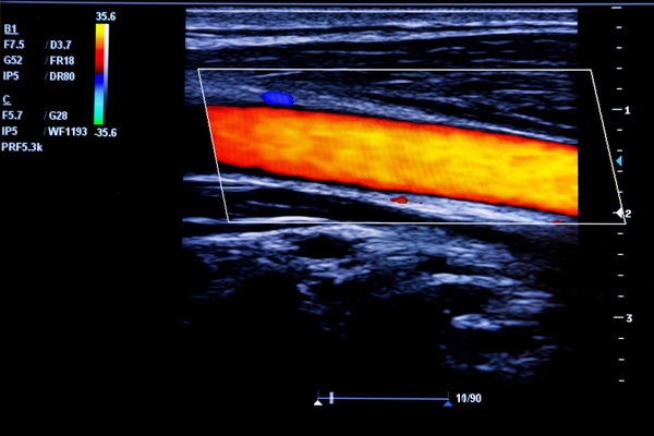 ultrasound image of carotid artery