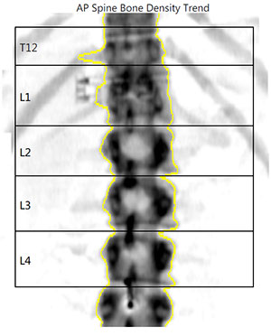 X-ray of spinal bone density from DEXA scan