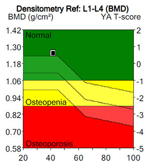 Densitometry reference chart from DEXA differentiating between normal and osteoporosis scores