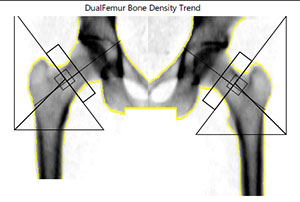 DualFemur Bone Density from DEXA Scan, x-ray of hips and top portion of legs