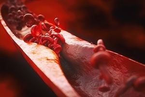 3D rendering of atherosclerosis, otherwise known as plaque buildup in the arteries. An illustration demonstrating the beginning of a blood clot as the bloodstream is slowed by thickened arterial walls
